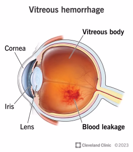 Hemorragia vítrea Hemorragia vítrea: entendiendo esta condición ocular y su manejo