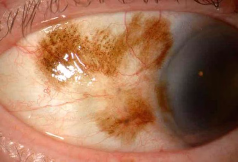 Melanosis conjuntival: descripción, diagnóstico y tratamiento de esta lesión ocular benigna