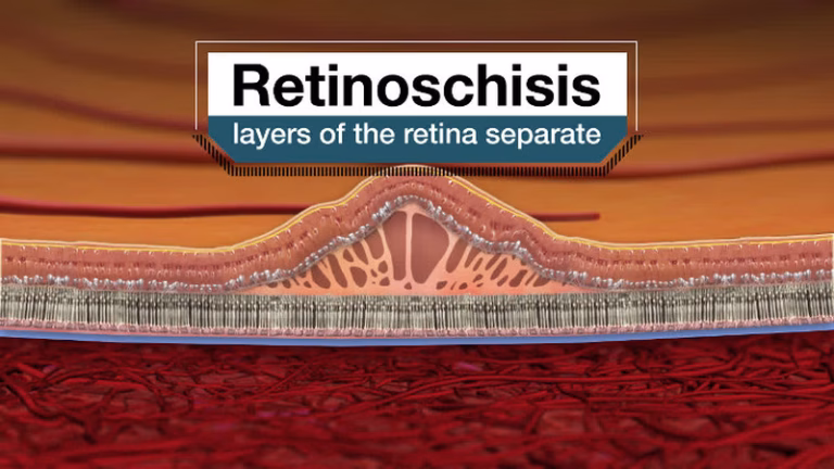 Retinosquisis: causas, síntomas y opciones de tratamiento para esta afección retiniana