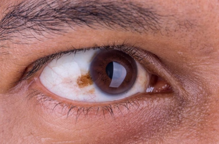 Tumores oculares: tipos, síntomas y opciones de tratamiento para las enfermedades malignas oculares
